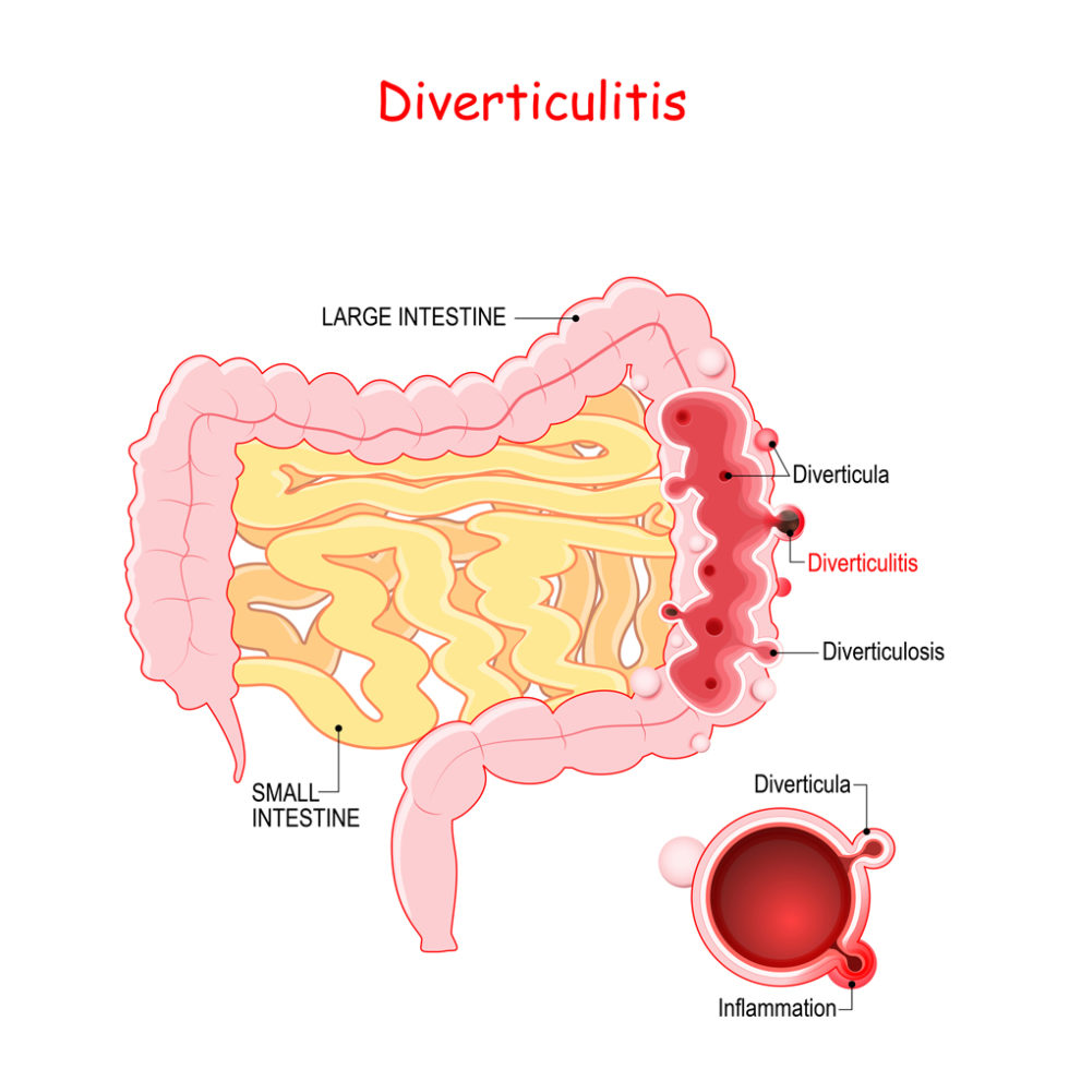 Diverticulitis In Raleigh NC UNC REX Colorectal Surgery